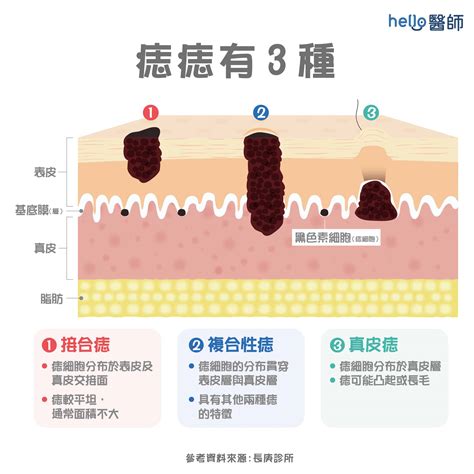 眼睛長痣|痣形成的原因？痣長毛、痣變多變大是痣病變？5招判別